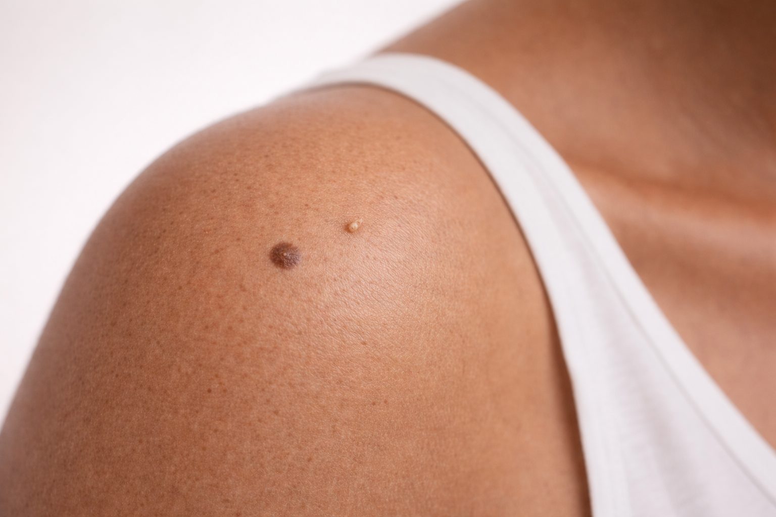 Lésion cutanée sur l'épaule avant chirurgie médicoesthétique mineure à la clinique Le Centre au Québec | Skin lesion on the shoulder before minor medico-aesthetic surgery at Le Centre clinic in Quebec