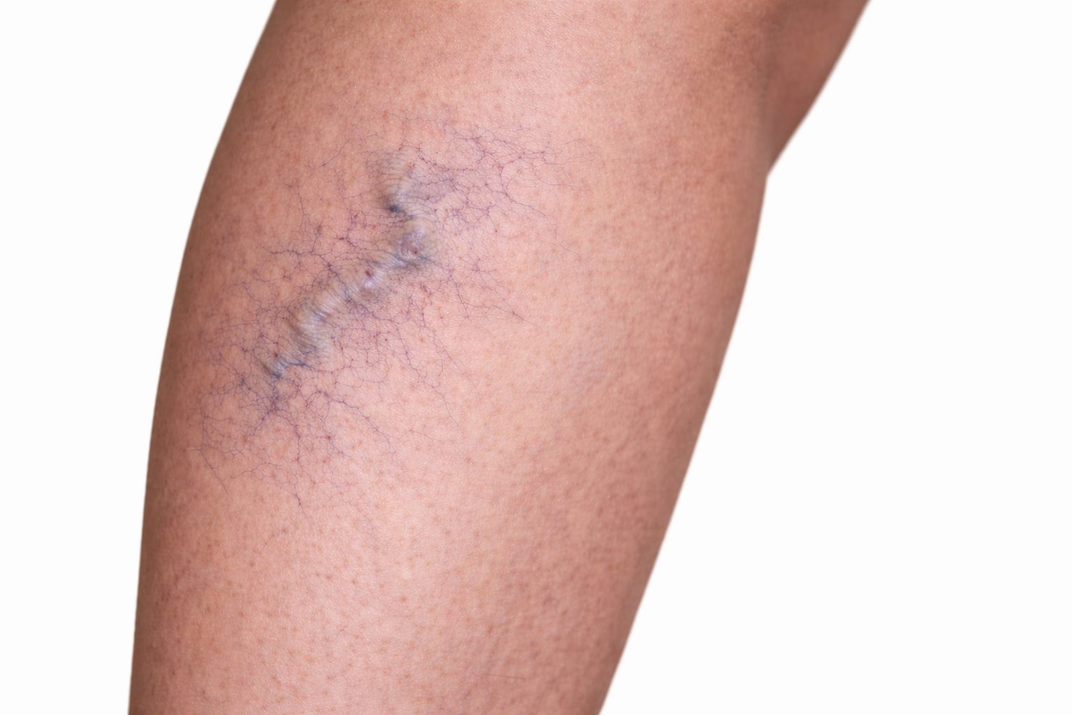 Varices visibles sur la jambe avant échosclérose guidée par ultrasons à la clinique Le Centre au Québec | Visible leg varicose veins before ultrasound-guided echosclerotherapy at Le Centre clinic in Quebec