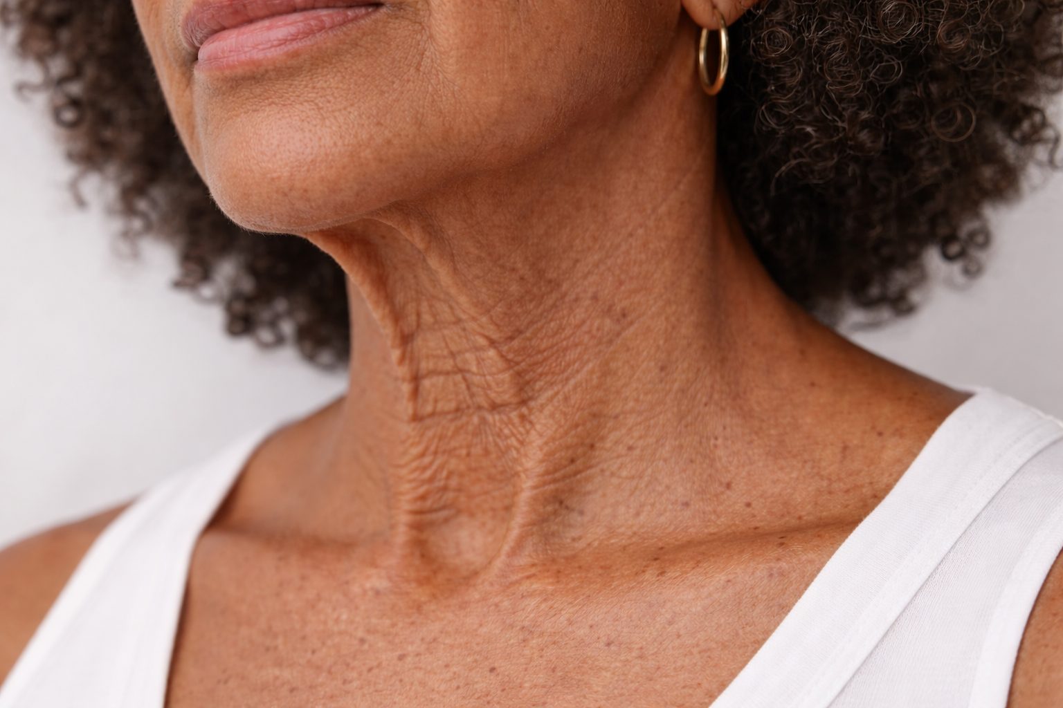 Ridules, relâchement et texture du cou avant traitement de rajeunissement du cou à la clinique Le Centre au Québec | Neck lines, laxity and skin texture before neck rejuvenation treatment at Le Centre clinic in Quebec
