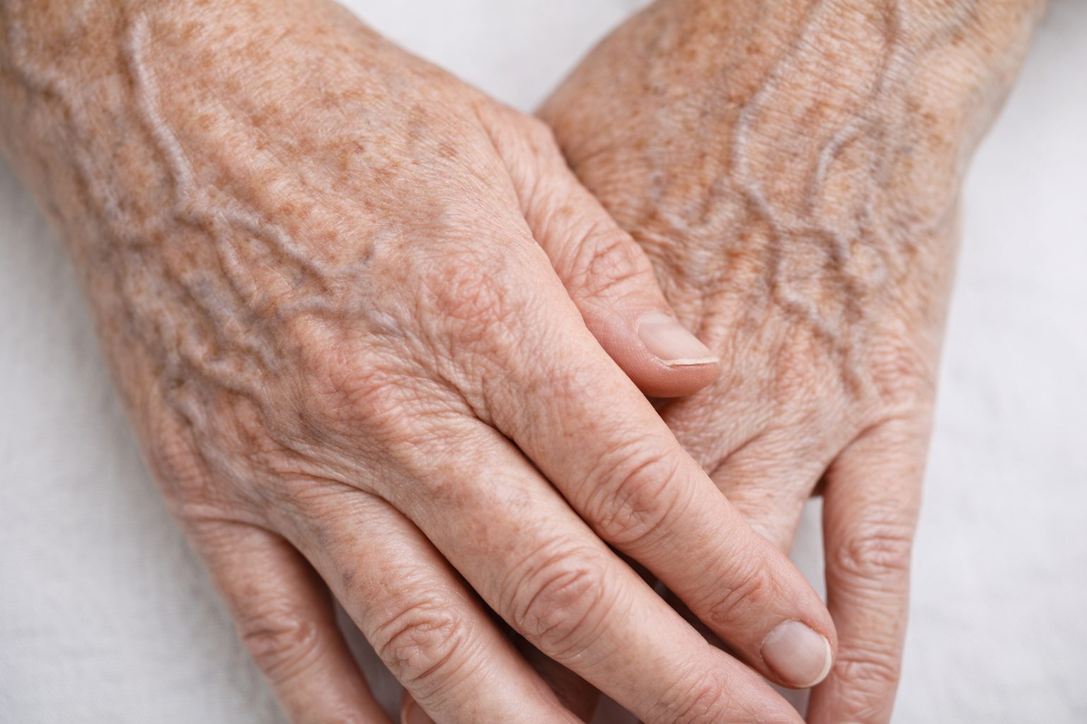 Mains avec perte de volume, veines visibles et taches avant traitement de rajeunissement des mains à la clinique Le Centre au Québec | Hands with volume loss, visible veins and spots before hand rejuvenation treatment at Le Centre clinic in Quebec